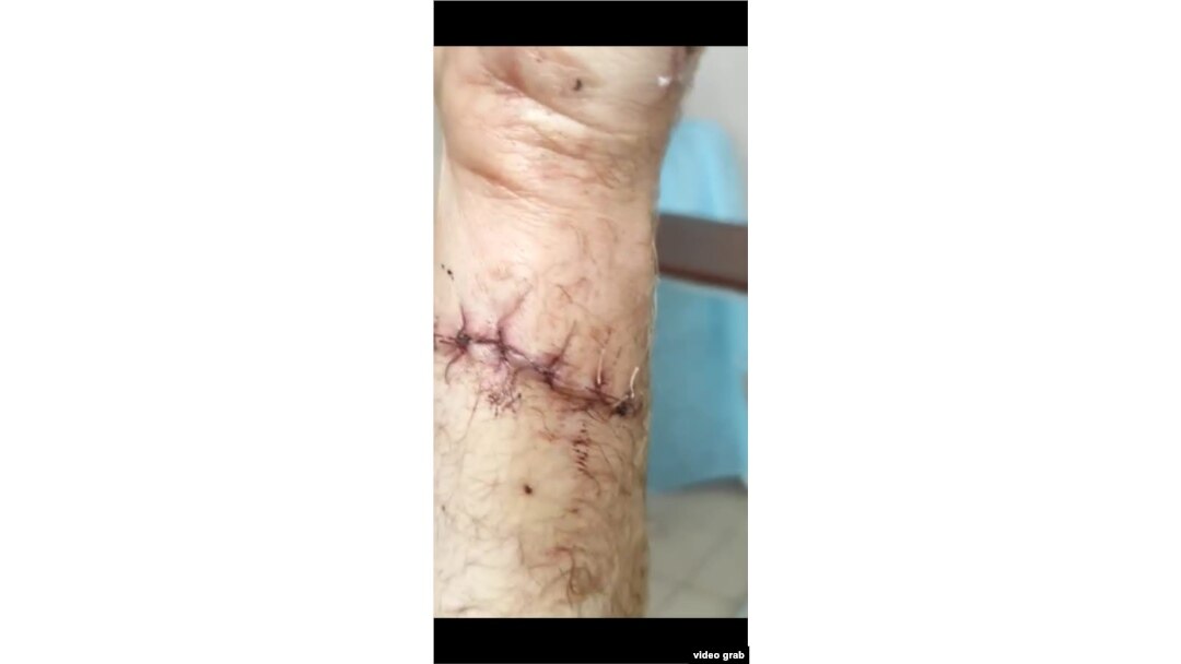 Зашитая рука Константина Роголевского после ножевого ранения. Скриншот видео из больницы после операции. Июль 2022 года