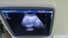 Türkmenistanyň abort gadaganlygy parahorlyga ýol açýar